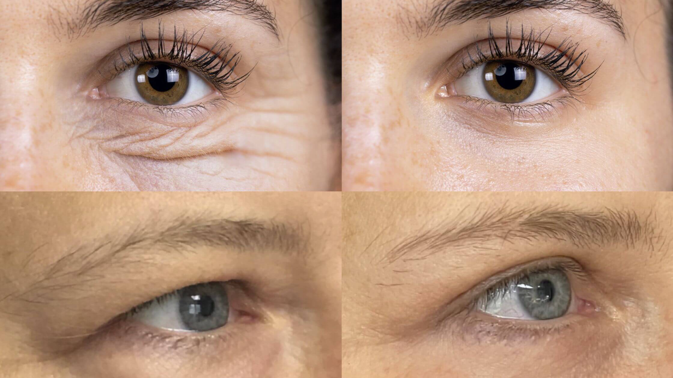 Blefaroplastia