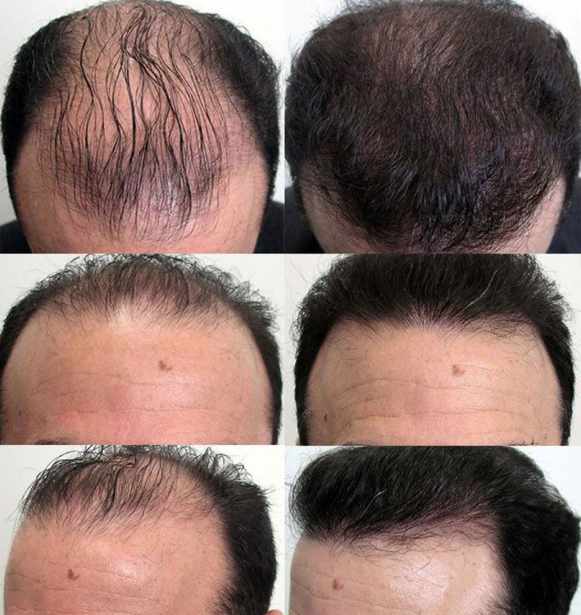 Resultado de transplante capilar com foco em naturalidade antes da evolucao final