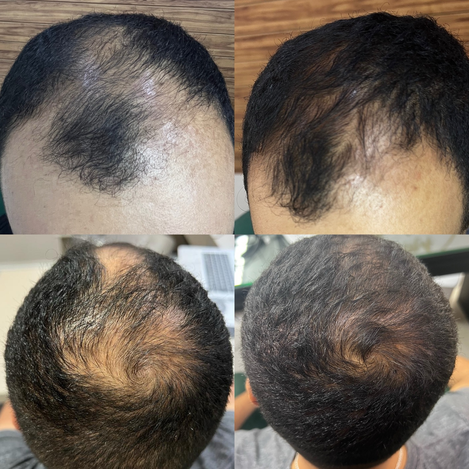 Paciente de 38 anos antes do transplante capilar