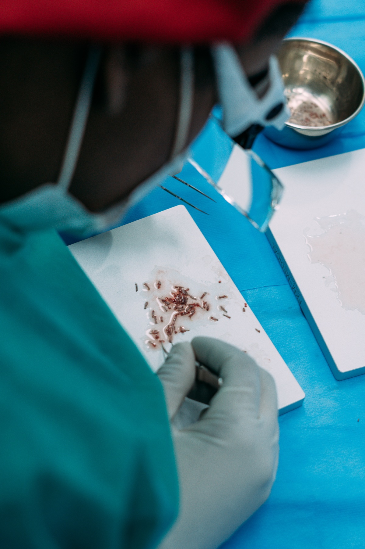 Tecnica FUE para extracao de unidades foliculares no transplante capilar