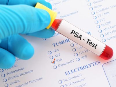 Blood sample for PSA test, diagnosis for prostate cancer